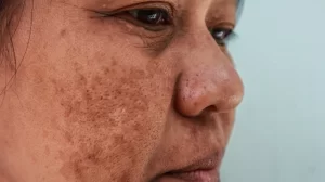 How Do You Know You Have Melasma?