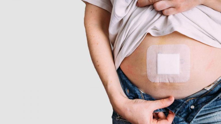 Lifestyle Changes to Keep You Safe from Hernias