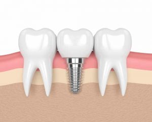 Who Makes the Best Candidate for Dental Implants?
