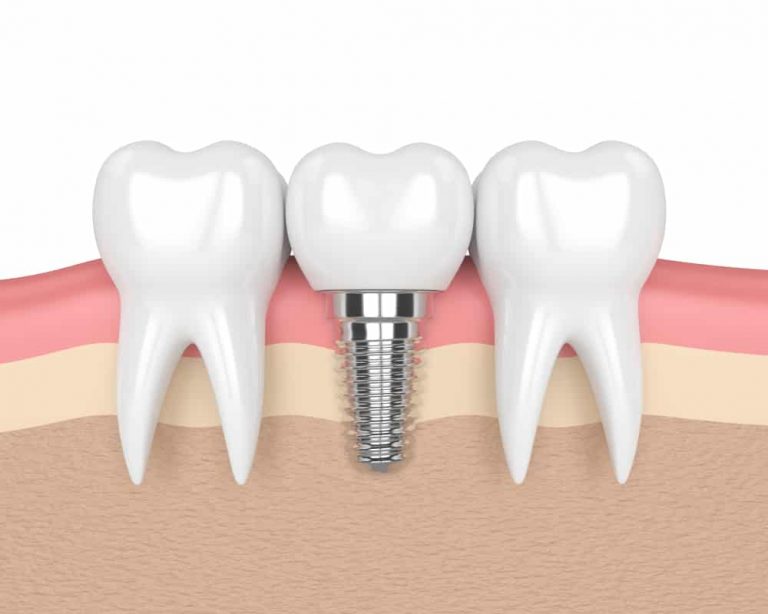 Who Makes the Best Candidate for Dental Implants?