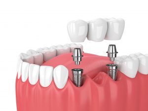 How to Know If Dental Implants Are Necessary