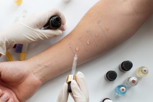 What You Should Know About Doing a Skin Test for Allergies