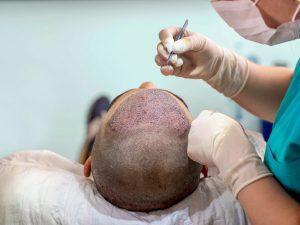 Tips for Choosing a Hair Transplant Surgeon