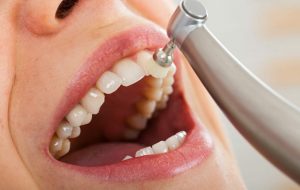 7 Health Benefits of Routine Teeth Cleaning