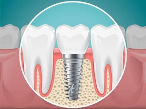 Why Dental Implants Are Worth It: 8 Key Reasons