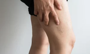 All you need to know concerning deep vein thrombosis