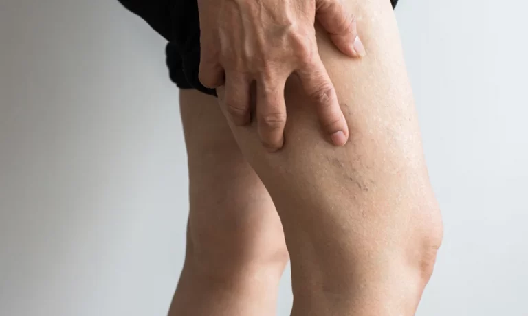 All you need to know concerning deep vein thrombosis