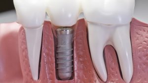 Retreatment Rationale: Exploring the Need for Root Canal Redos